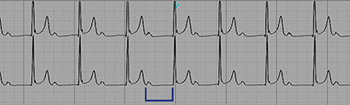 First-degree AV block (AV block I, AV block 1) – ECG & ECHO