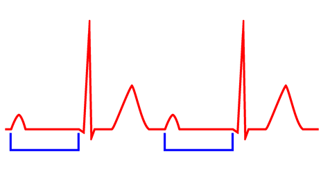 First-degree AV block (AV block I, AV block 1) – ECG & ECHO