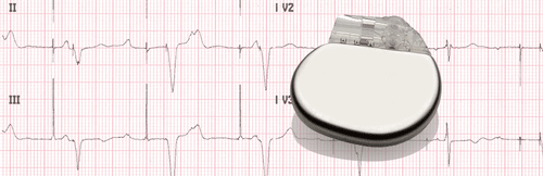 ECG d'un pacemaker électrique