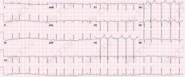 Electrocardiograma de Taquicardia Auricular Multifocal